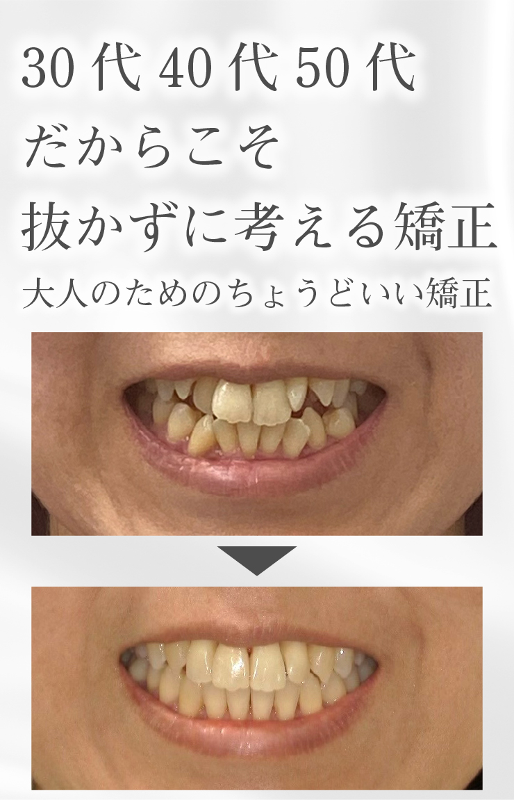 30・40・50代のためのちょうどいい歯列矯正
