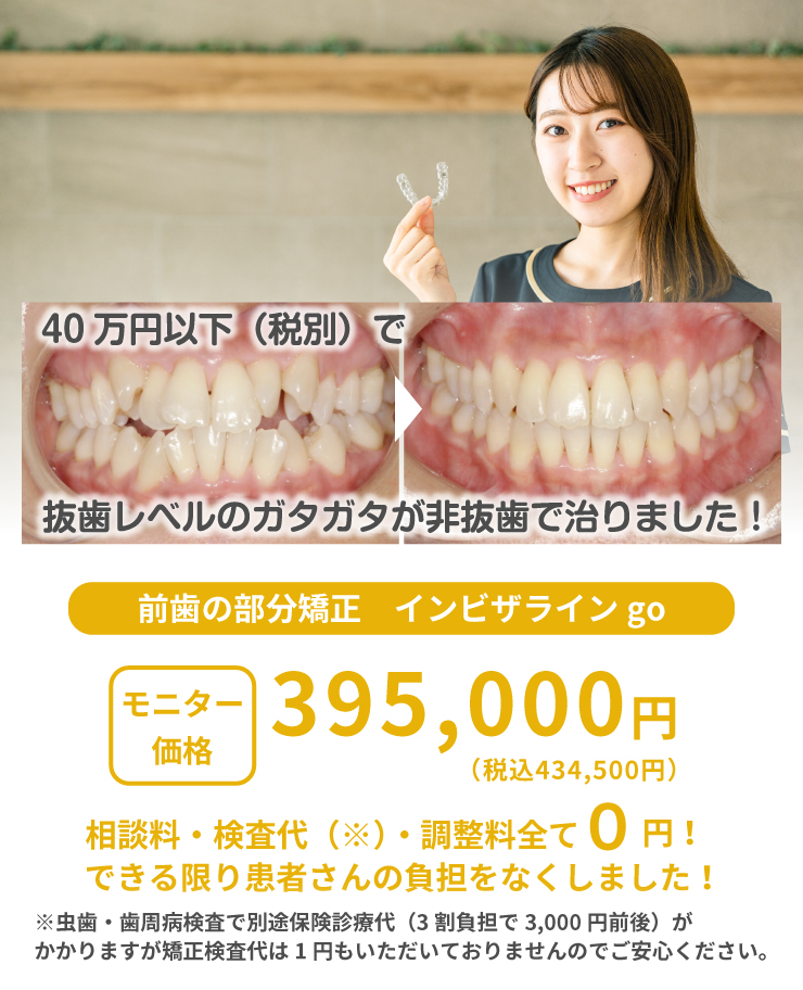 インビザライン go