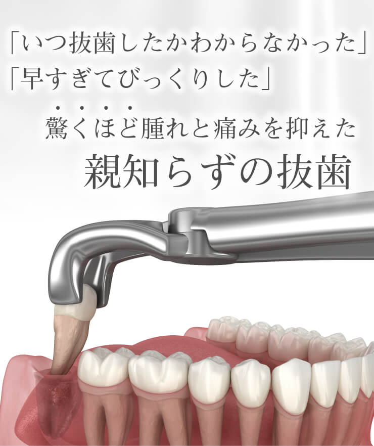 親知らずの抜歯