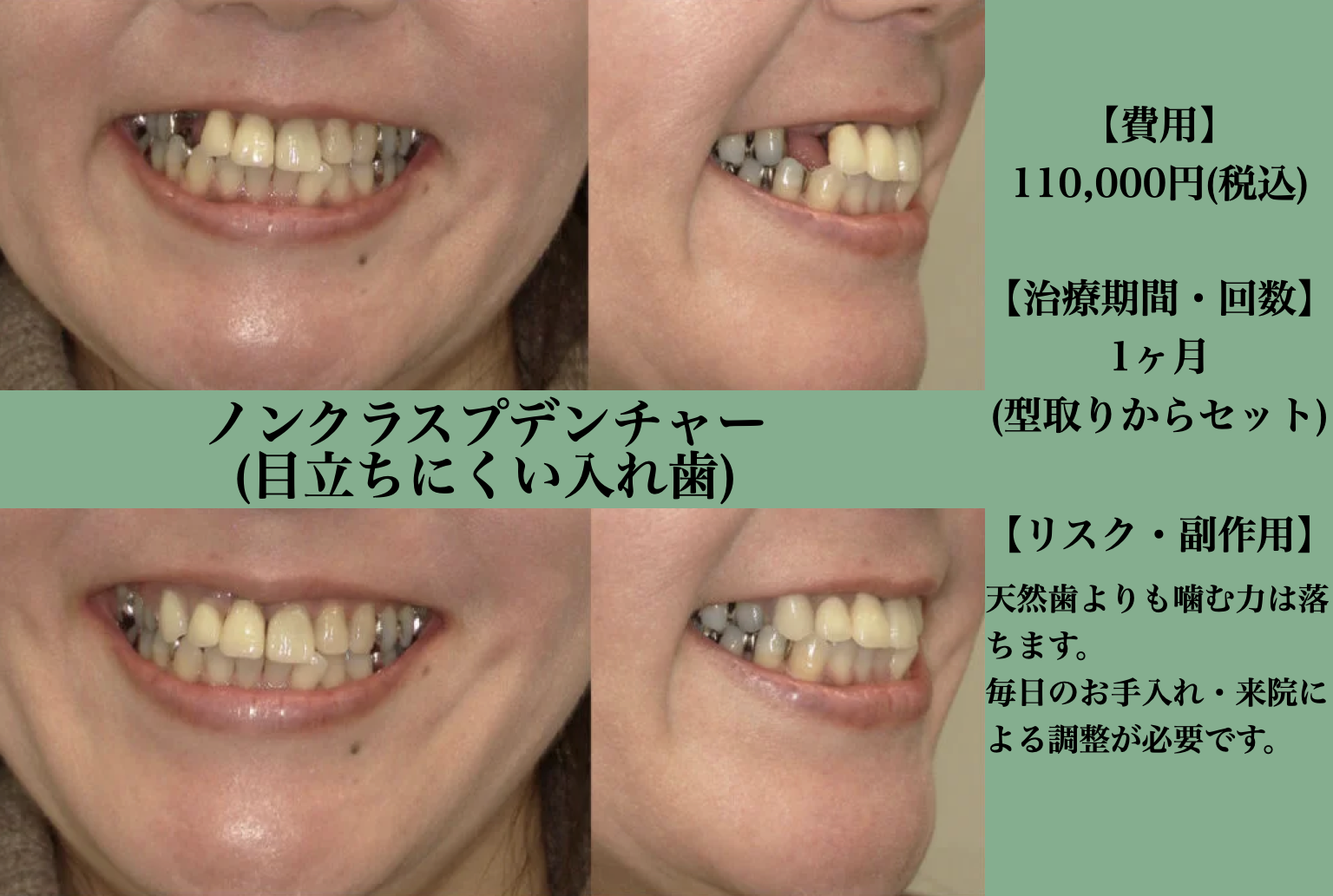目立た ない 入れ歯